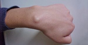 riconoscere e debellare le cisti