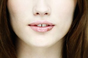 herpes labiale