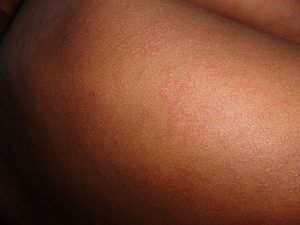 morbillo