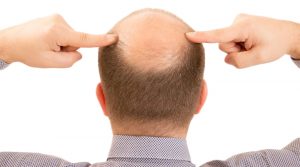 alopecia